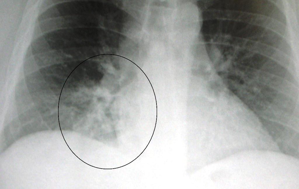 Inilah Gejala Awal Pneumonia dan Cara Pencegahan yang Perlu Diketahui!